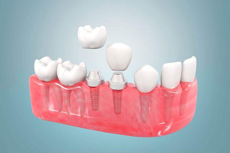 dental implants near you