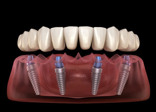 all on x implants