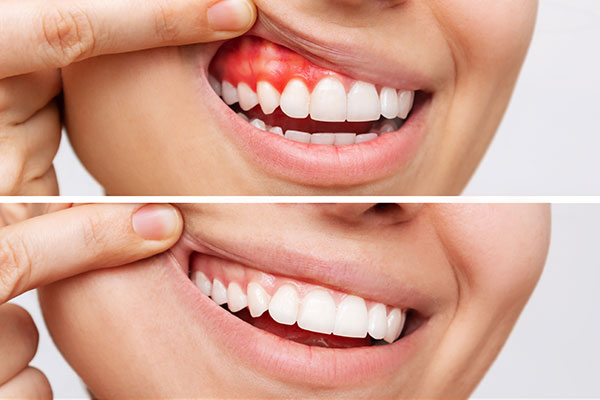 Inflamed gums and healthy gums comparison illustrating periodontal maintenance at Algoma Family Dentistry.